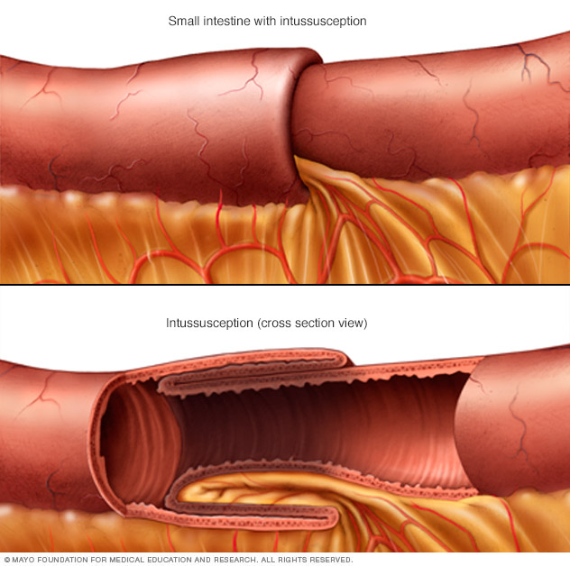 intestinal-obstruction-disease-reference-guide-drugs